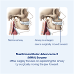 Obstructive Sleep Apnea Patient Information Pamphlet (100-Pack)