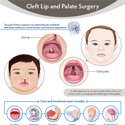 Cleft Lip and Palate Surgery Infographic (PDF)