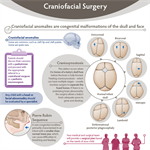 Craniofacial Surgery Infographic (PDF)